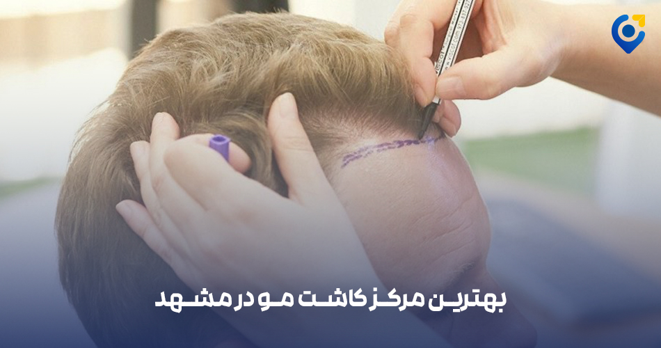 بهترین مرکز کاشت مو در مشهد